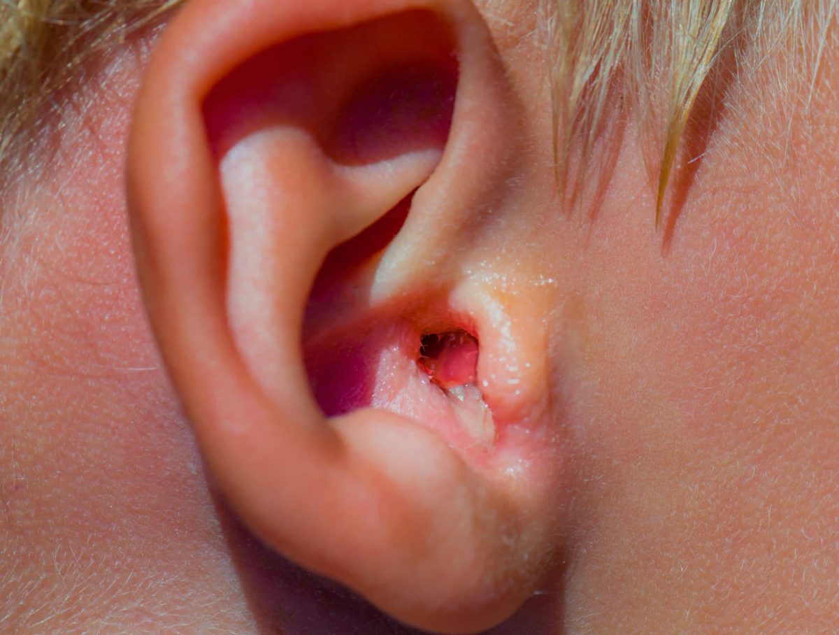 swimmers ear infection