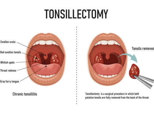 Tonsillectomy